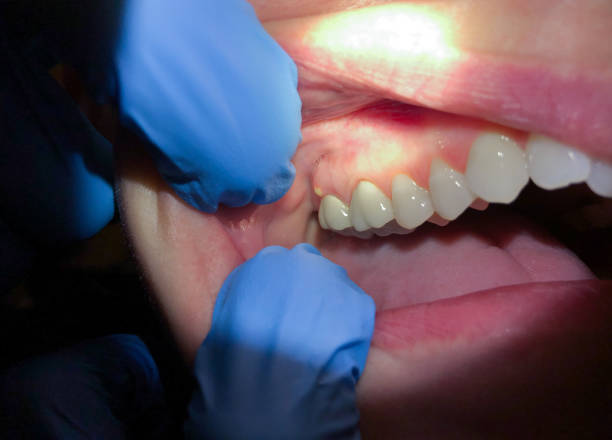 Best Urgent Care for Lost Fillings or Crowns in West Peoria, IL